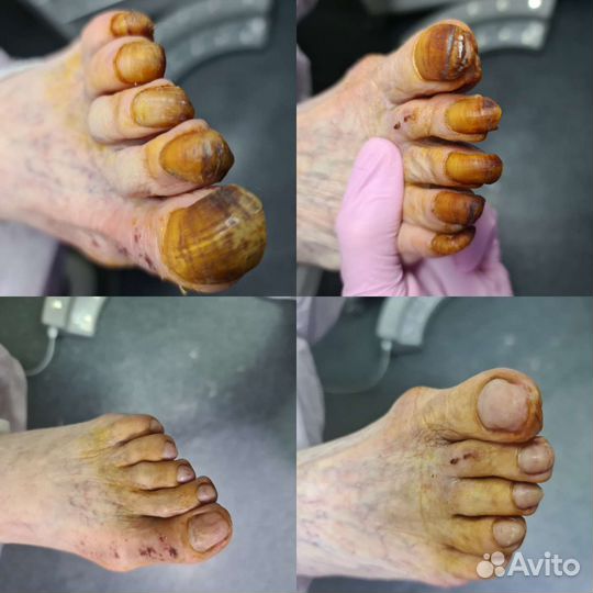 Аппаратный педикюр