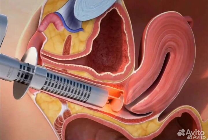 Сужение влагалища и лечение недержания мочи