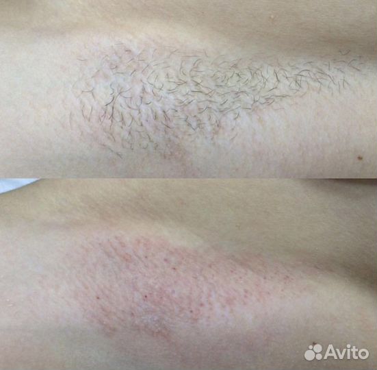Электроэпиляция