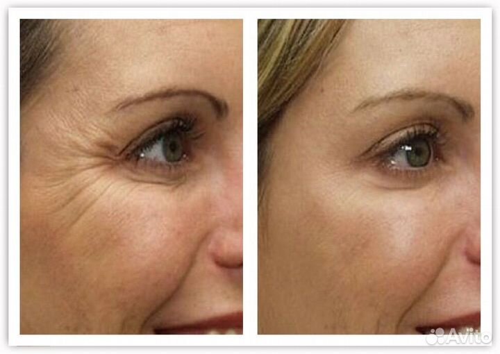 Ботокс для лица