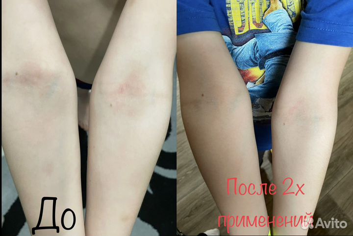 Бальзам от экземы/псориаза/ дерматита и др. 7,5 гр