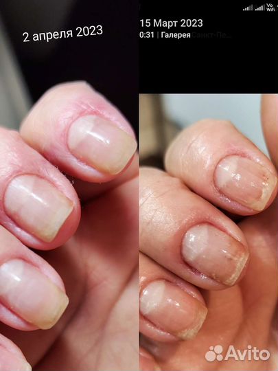 Реальное лечение грибка и вросших ногтей