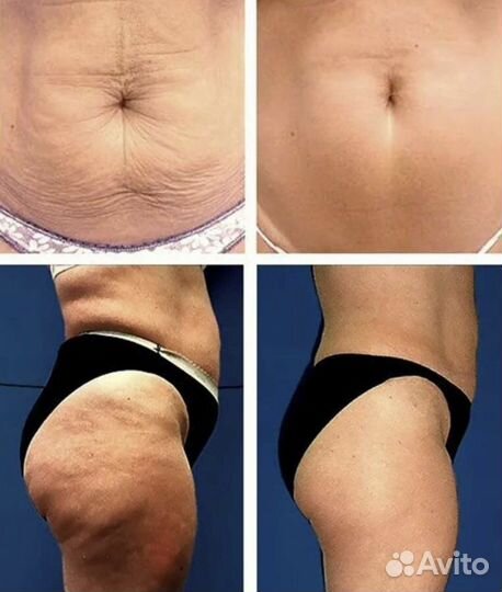 Коррекция фигуры Liposonic / Похудение без диет