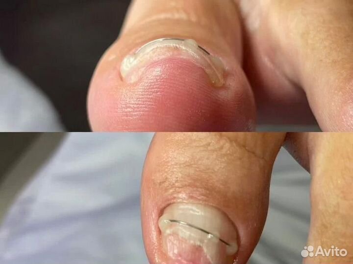 Медицинский педикюр, подолог