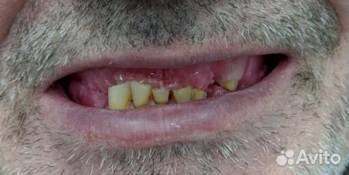 Съемные зубные протезы