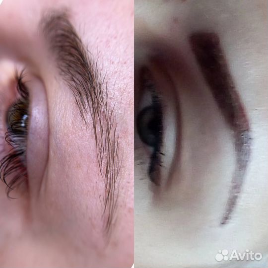 Лазерное удаление татуировок и татуажа