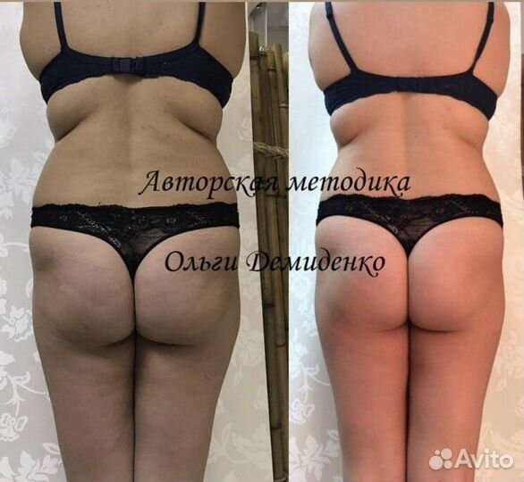 Коррекция фигуры в Москве