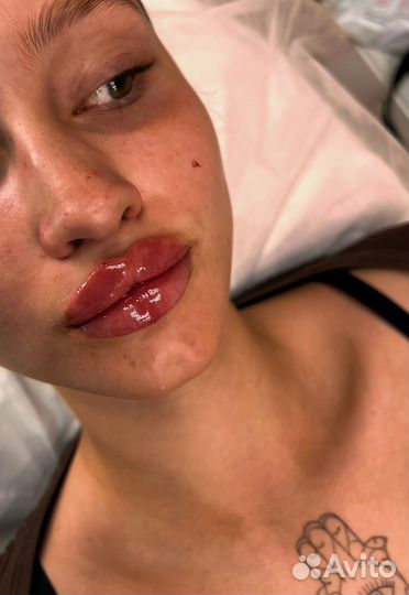 Увеличение губ