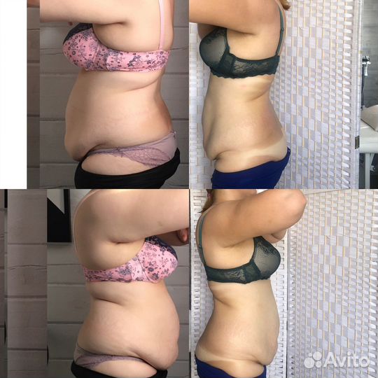 Обучение аппаратным методикам коррекции фигуры