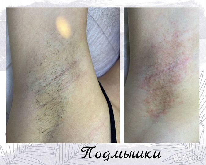 Электроэпиляция: бёдра