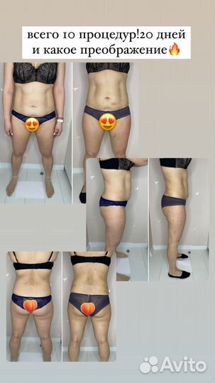 LPG массаж, микроигольчатый RF-лифтинг, кавитация