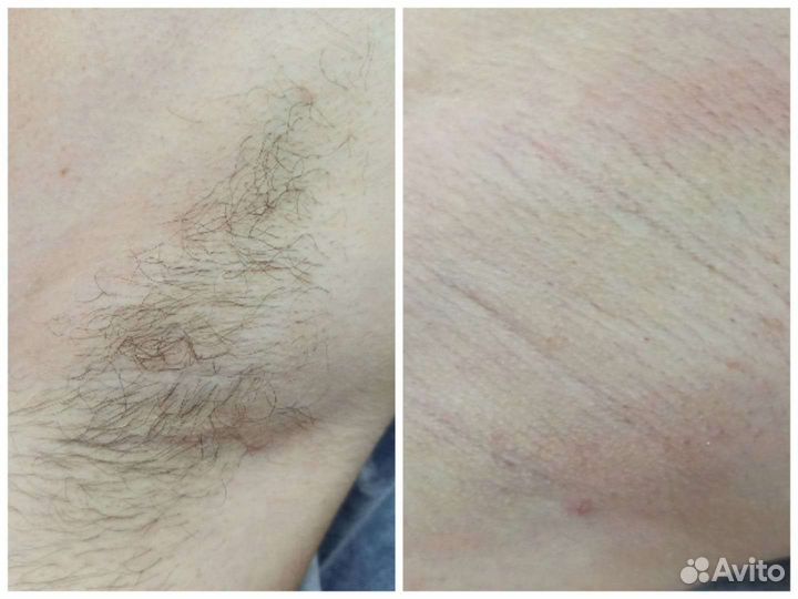 Восковая депиляция