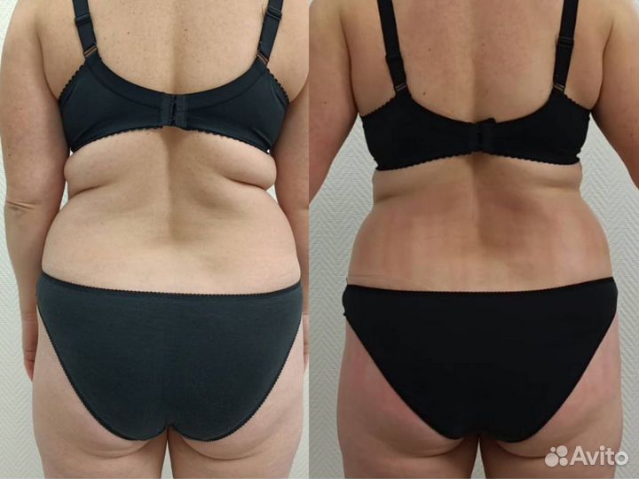 Массаж LPG тела, аппаратный массаж, похудение