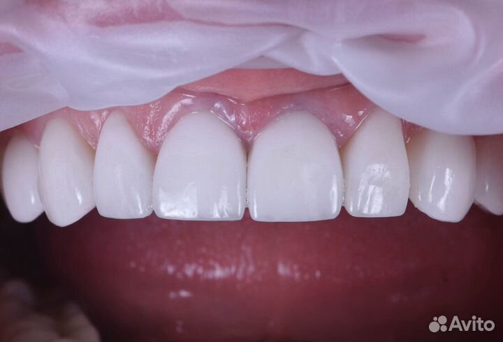 Виниры Керамические - без обточки