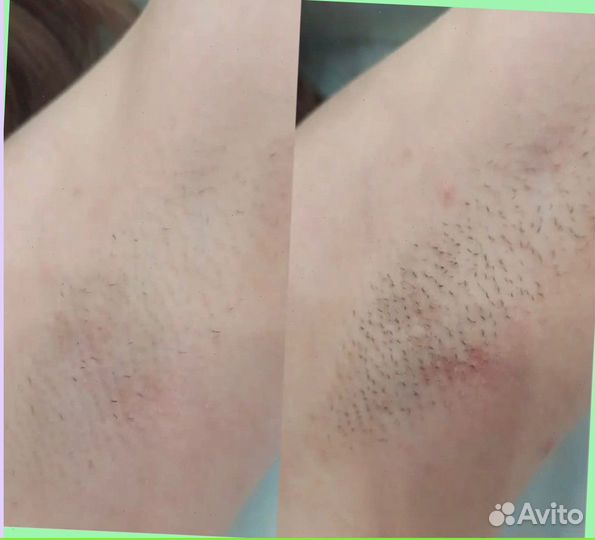 Эпиляция лазером премиум класса