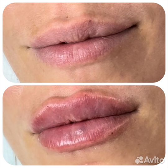 Иньекционная косметология и не только