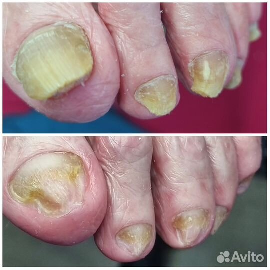 Грибок ногтей (Микоз). Подолог Липецк