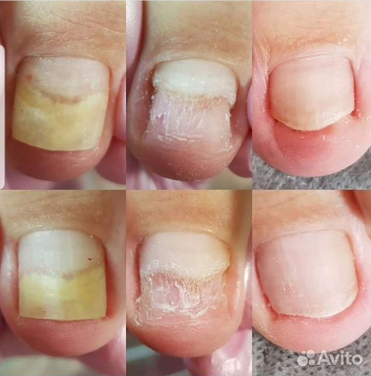 Аппаратный педикюр