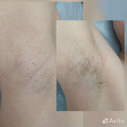 Депиляция Шугаринг в салоне
