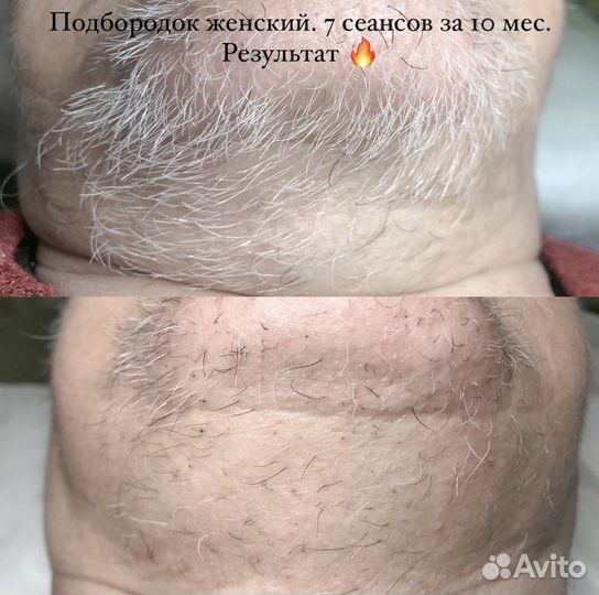 Электроэпиляция