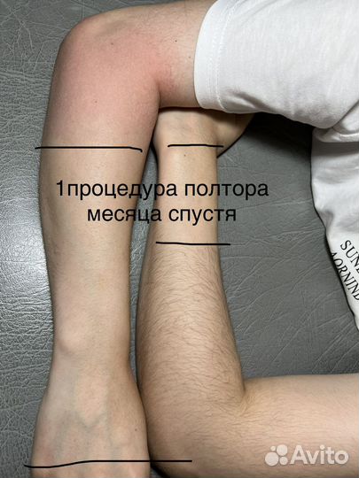 Электроэпиляция