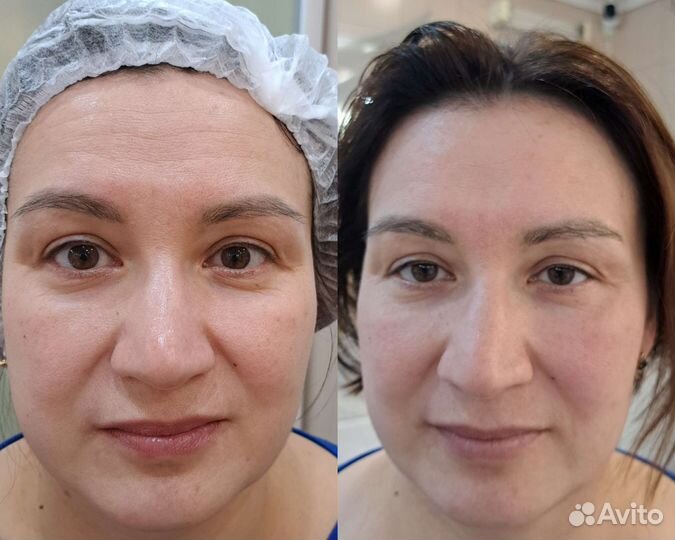 Массаж по лицу