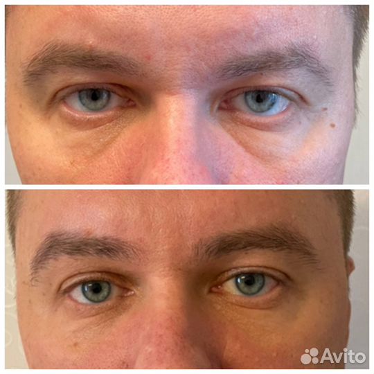 Безоперационная Блефаропластика