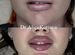 Увеличение губ, косметолог, Профиль Джоли