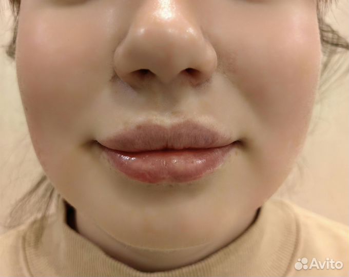 Увеличение губ