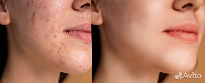 Профессиональная ретушь лица, обработка фото