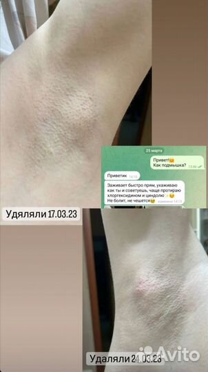 Электроэпиляция модель