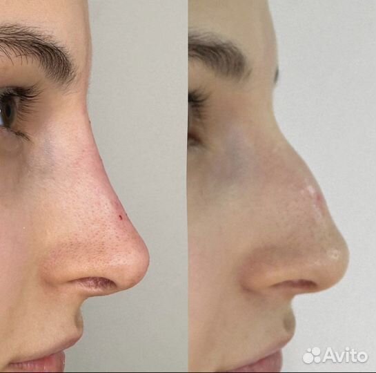 Биоревитализация