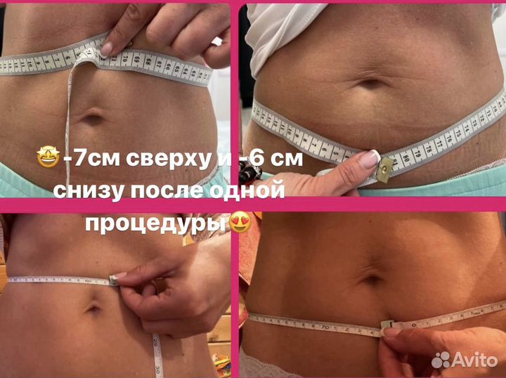 Кетгут похудение/акупунктурный фейслифтинг