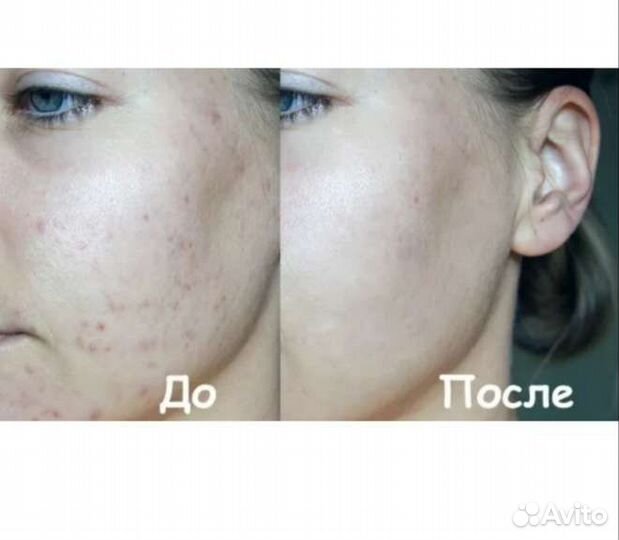 Болтушка от прыщей