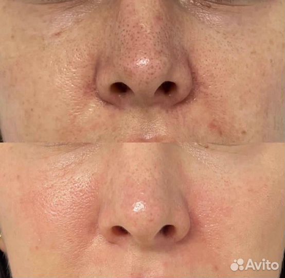 Чистка лица