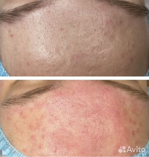 Косметолог чистка лица