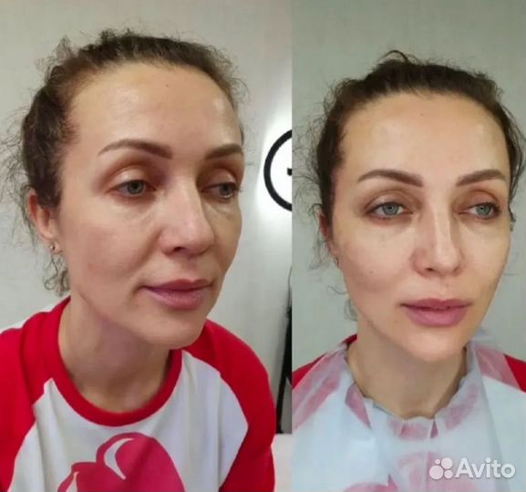 Коктейль Монако + ботокс