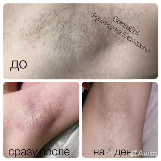 Электроэпиляция