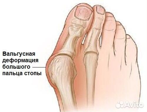 Фиксаторы-корректоры большого пальца