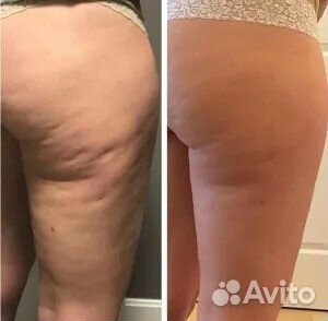 Exilis Ultra 360 RF лифтинг тела похудение