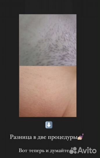 Лазерная эпиляция