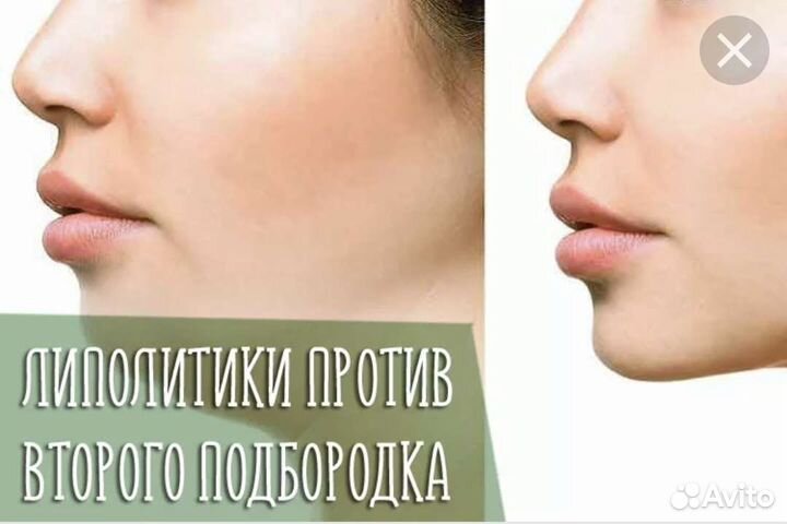 Увеличение губ