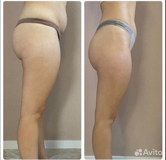 Аппаратный массаж