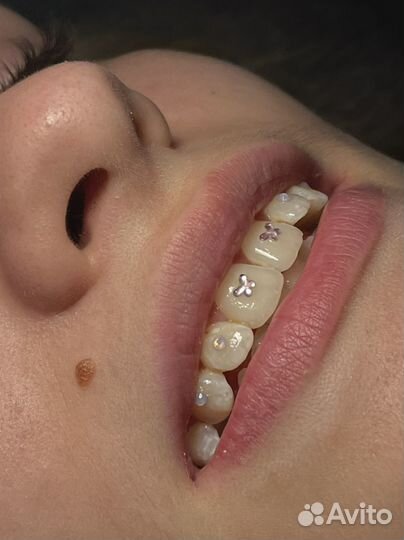 Установка скайсов