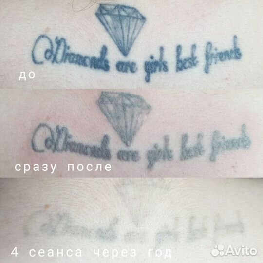 Лазерное удаление тату