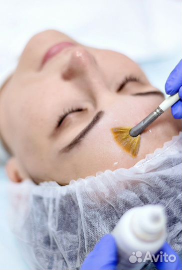 Химический пилинг