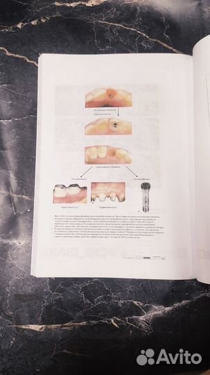 Нулевая утрата кости книга