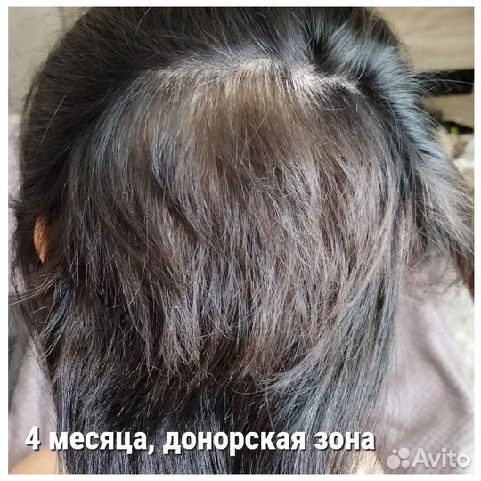 Пересадка волос в Турции