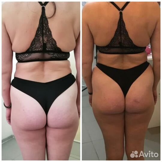 LPG массаж плюс костюм дарю