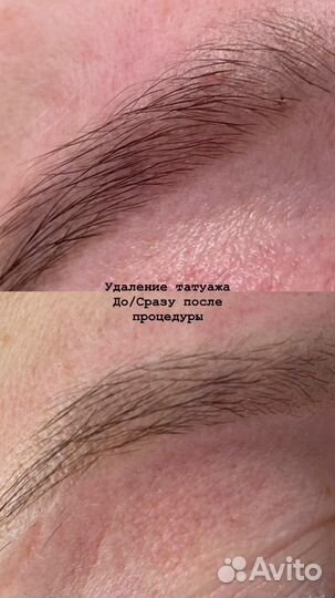 Лазерное удаление тату/татуажа